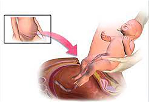 cesarean-section.jpg