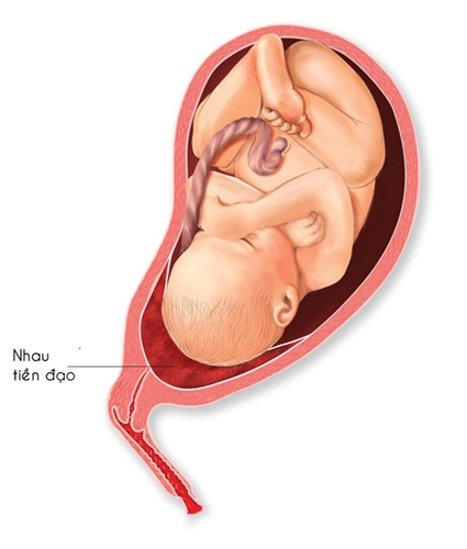 placentaprevia.jpg