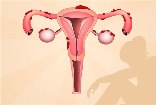 endometriosis.jpg